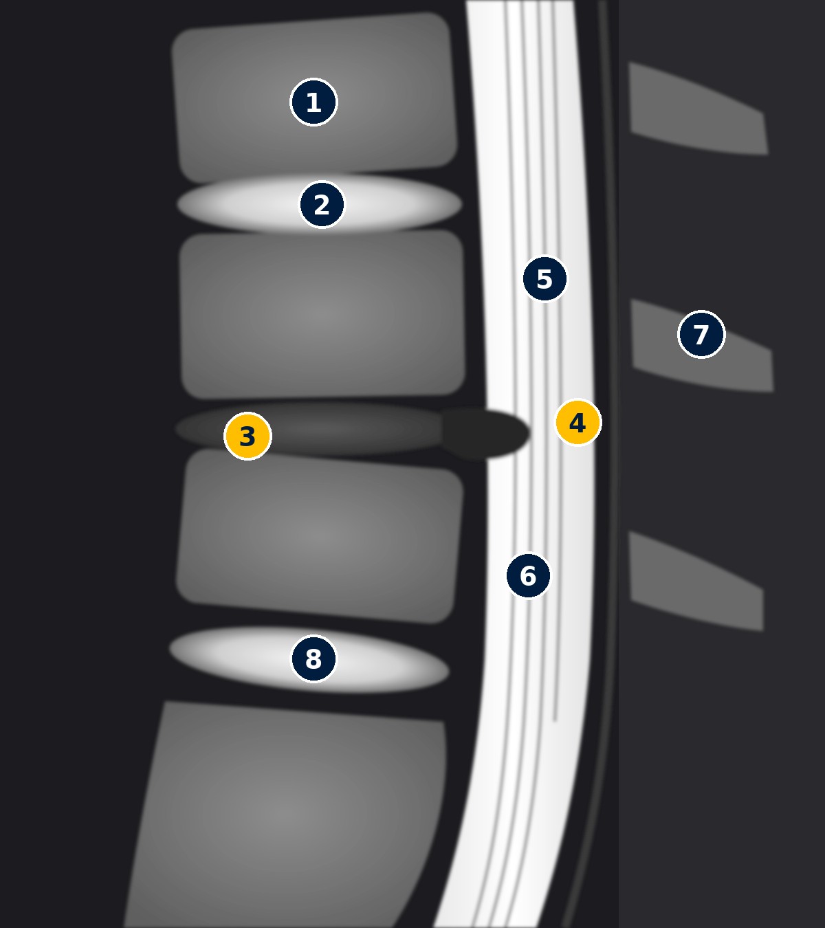 Schema di risonanza magnetica sagittale T2 della colonna lombare: dischi sani chiari e disco L4-L5 scuro e abbassato