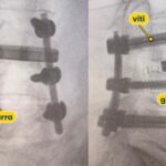 Scopia intraoperatoria anonima di un'artrodesi lombare: viti e barre posteriori e gabbietta intersomatica, con etichette
