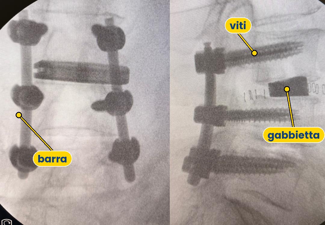Scopia intraoperatoria anonima di un'artrodesi lombare: viti e barre posteriori e gabbietta intersomatica, con etichette