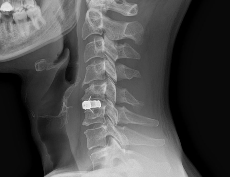 Radiografia laterale dopo artrodesi cervicale C5-C6 (immagine anonimizzata)