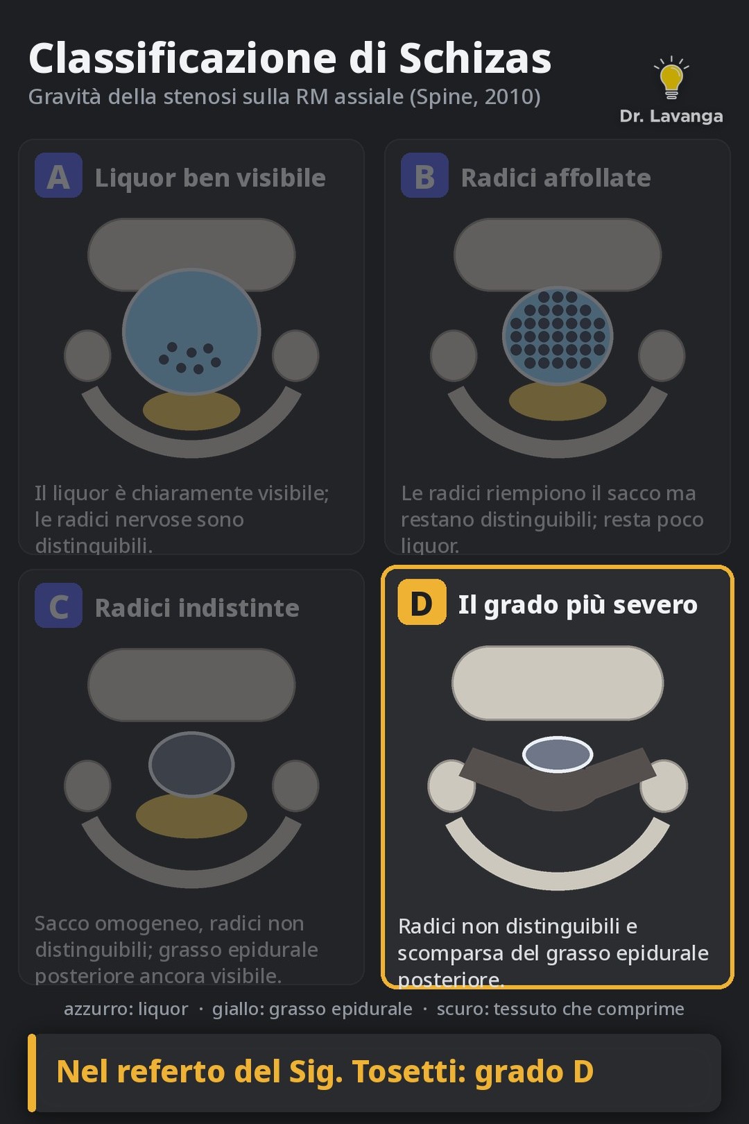 I quattro gradi A, B, C e D della classificazione di Schizas per la stenosi lombare
